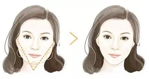 瘦臉針適合什么人打？瘦臉針適合什么臉型？