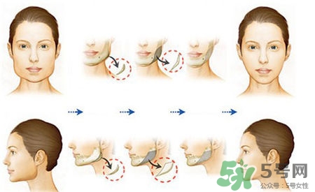 瘦臉針進口好還是國產(chǎn)好？瘦臉針國產(chǎn)和進口的區(qū)別