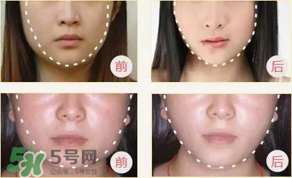 打完瘦臉針多久可以化妝？打完瘦臉針的反應