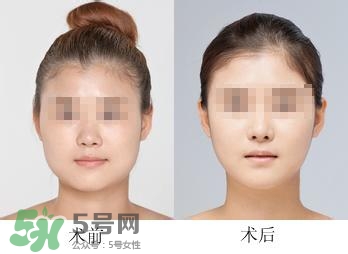 打瘦臉針能喝酒嗎？打瘦臉針能吃海鮮嗎？