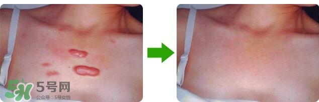 祛疤痕最好的方法有哪些？祛疤痕的簡單方法