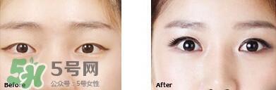 開(kāi)眼角要恢復(fù)多久？開(kāi)眼角好不好？