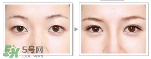 割雙眼皮有什么后遺癥嗎？割雙眼皮有什么危害性？