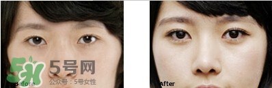 開(kāi)眼角要恢復(fù)多久？開(kāi)眼角好不好？