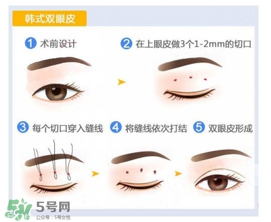 割雙眼皮有幾種做法？雙眼皮有哪幾種形狀？
