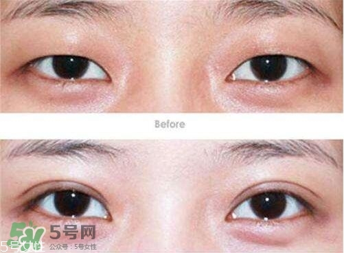 割雙眼皮有幾種做法？雙眼皮有哪幾種形狀？