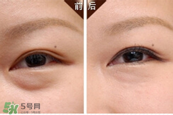 臥蠶是黑眼圈嗎？臥蠶和黑眼圈的區(qū)別