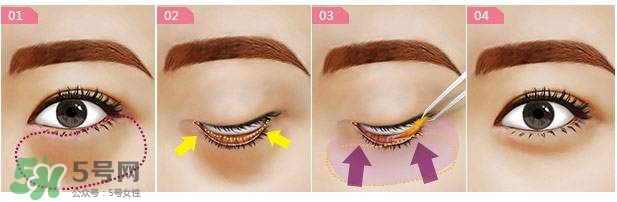 眼袋是怎么形成的？手術(shù)去眼袋安全嗎