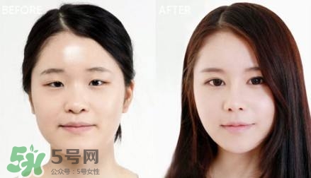 割雙眼皮有什么后遺癥嗎？割雙眼皮有什么危害性？