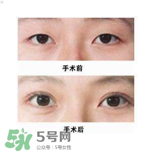 割雙眼皮疼不疼？割雙眼皮疼幾天能好？