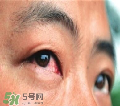 紅眼病是怎么引起的？紅眼病怎么產生的