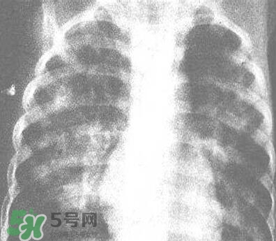 紅眼病是怎么引起的？紅眼病怎么產生的