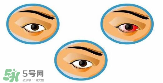 紅眼病用什么眼藥水好？紅眼病吃什么好得快