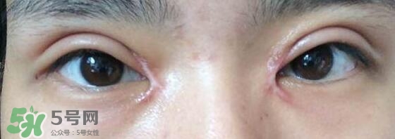 眼角增生是什么意思？眼角增生了怎么辦？
