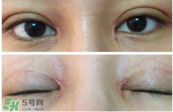 眼角增生是什么意思？眼角增生了怎么辦？