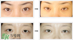 哪些人需要開(kāi)眼角？需要開(kāi)眼角的眼睛圖片