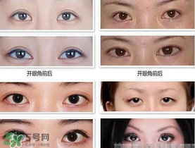 哪些人需要開(kāi)眼角？需要開(kāi)眼角的眼睛圖片
