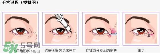 哪些人需要開(kāi)眼角？需要開(kāi)眼角的眼睛圖片