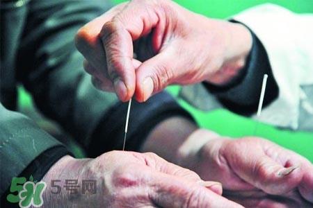 沒病可以針灸嗎？沒病可以扎針嗎？