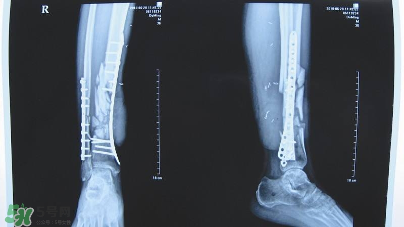 骨折吃什么好得快？骨折后注意事項(xiàng)