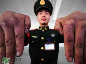 三月份還長(zhǎng)凍瘡嗎？三月份凍瘡沒(méi)好怎么辦？