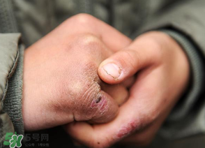 三月份還長(zhǎng)凍瘡嗎？三月份凍瘡沒(méi)好怎么辦？