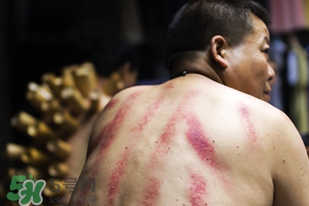 骨質(zhì)疏松可以刮痧嗎？骨質(zhì)疏松刮痧好嗎？