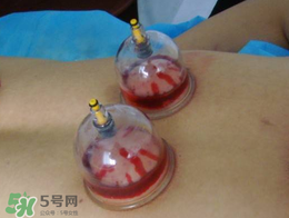 春天可以拔火罐嗎？春天適合拔火罐嗎？