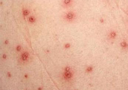 水痘是不是只長一次？水痘是不是長過就不會再長了？