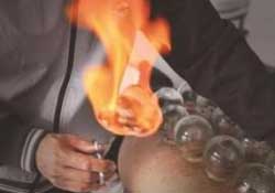 春天可以拔火罐嗎？春天適合拔火罐嗎？