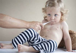 水痘隔離期為多少天？水痘的傳染期是多少天？