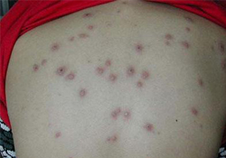 水痘會發(fā)燒嗎？小孩出水痘發(fā)燒怎么辦？