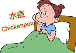 水痘是天花嗎？水痘是不是天花？