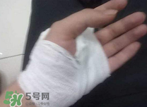 傷口化膿怎么處理？傷口化膿用什么藥好？