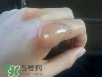 燙傷可以用牙膏嗎？燙傷用牙膏管用嗎？