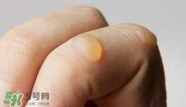 燙傷起泡要挑破嗎？燙傷起泡怎么處理？