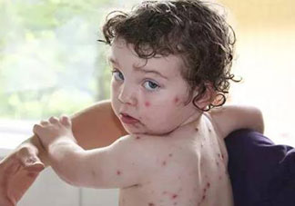 水痘結痂了還會傳染嗎?水痘結痂后還會傳染嗎?