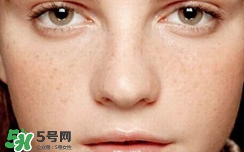 長(zhǎng)斑是什么原因引起的？祛斑效果最好的方法