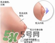 乳腺增生怎么根治 得了乳腺增生能根治嗎 乳腺增生怎么根治 得了乳腺增生能根治嗎