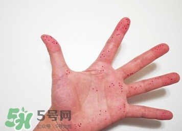 切辣椒后手很辣怎么辦？切辣椒后手很辣多久能好