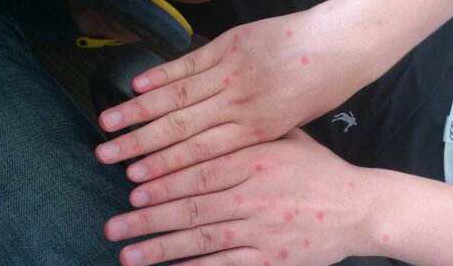 身上紅疙瘩是什么？身上紅疙瘩不痛不癢