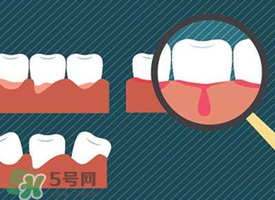 牙齦出血是什么原因？牙齦出血怎么回事