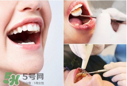 如何去掉牙結(jié)石？牙結(jié)石怎么去除