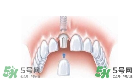 牙周炎能種植牙嗎？牙周炎能不能種植牙