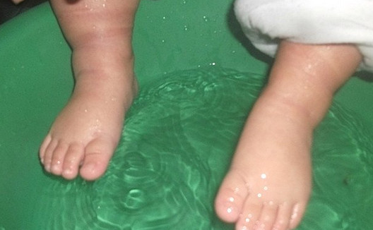 哪些人不適合泡腳？哪些人不宜泡腳