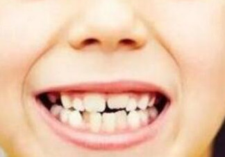 牙縫越來越大怎么辦？牙縫越來越大怎么修復