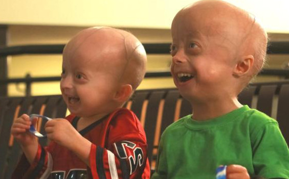 什么是早衰癥？早衰癥初期癥狀