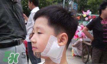 流行性腮腺炎怎么預(yù)防？流行性腮腺炎如何有效預(yù)防