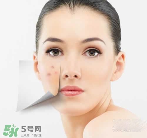 黑色痘印多久會(huì)消失？黑色痘印消失時(shí)間