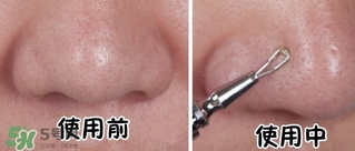 cosmos隱藏式青春痘棒粉刺針怎么樣？cosmos粉刺針多少錢(qián)？